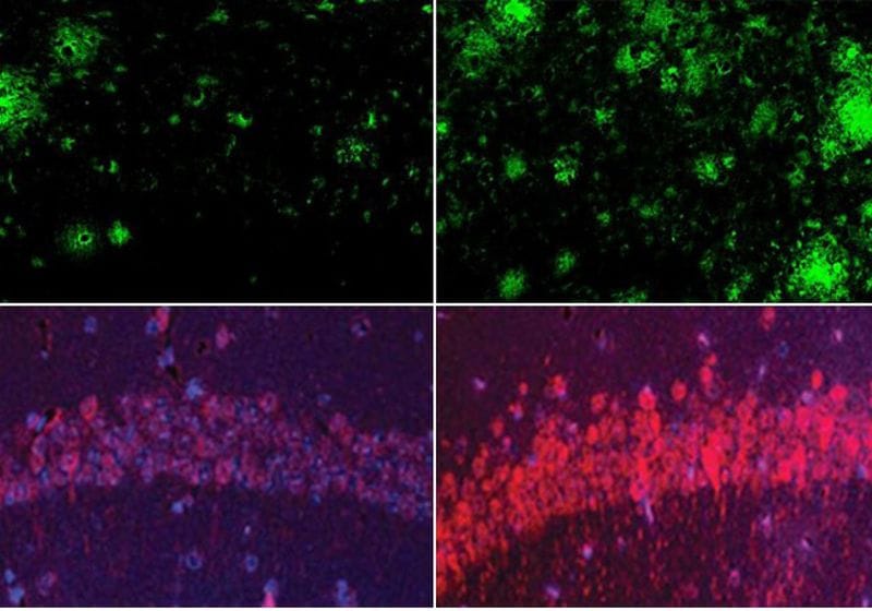 Low Brain Lithium Leads to Alzheimer’s Disease Pathology 1 Low Brain Lithium Leads to Alzheimer’s Disease Pathology
