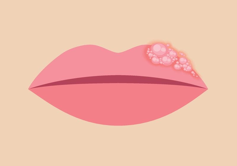 Herpes Hijacks a Host Enzyme. Blocking It Could Prevent Cold Sores. 1 Herpes Hijacks a Host Enzyme. Blocking It Could Prevent Cold Sores.